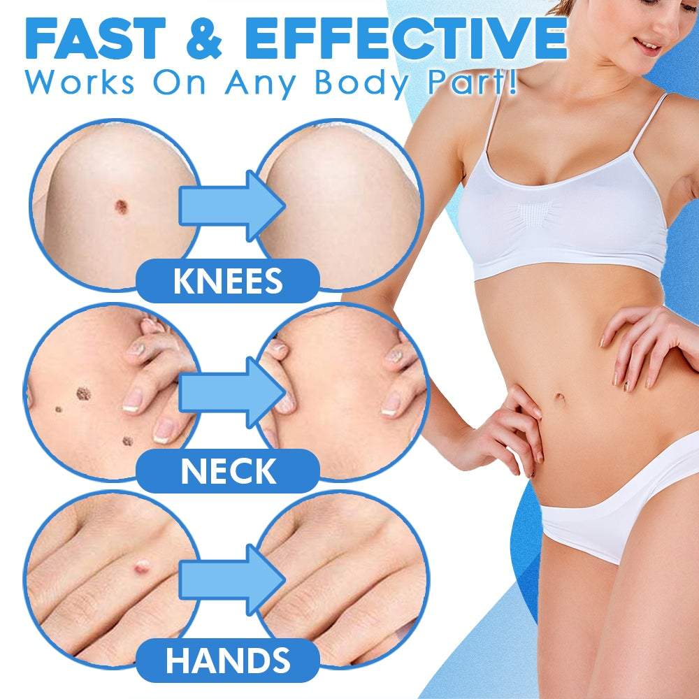 50% RABAT | FlawFix™ - Kit til fjernelse af filiforme vorter [Rabat på sidste dag]
